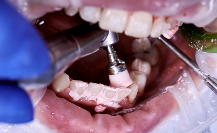 予防歯科の一つで歯のクリーニングをしている様子