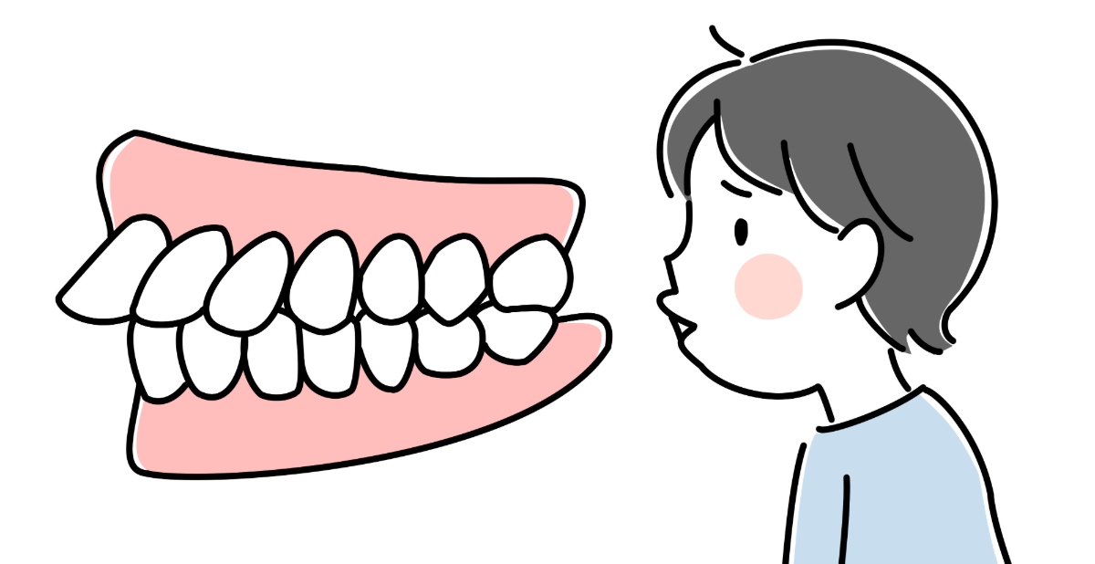 矯正を検討したほうがよい子どもの歯並びである出っ歯